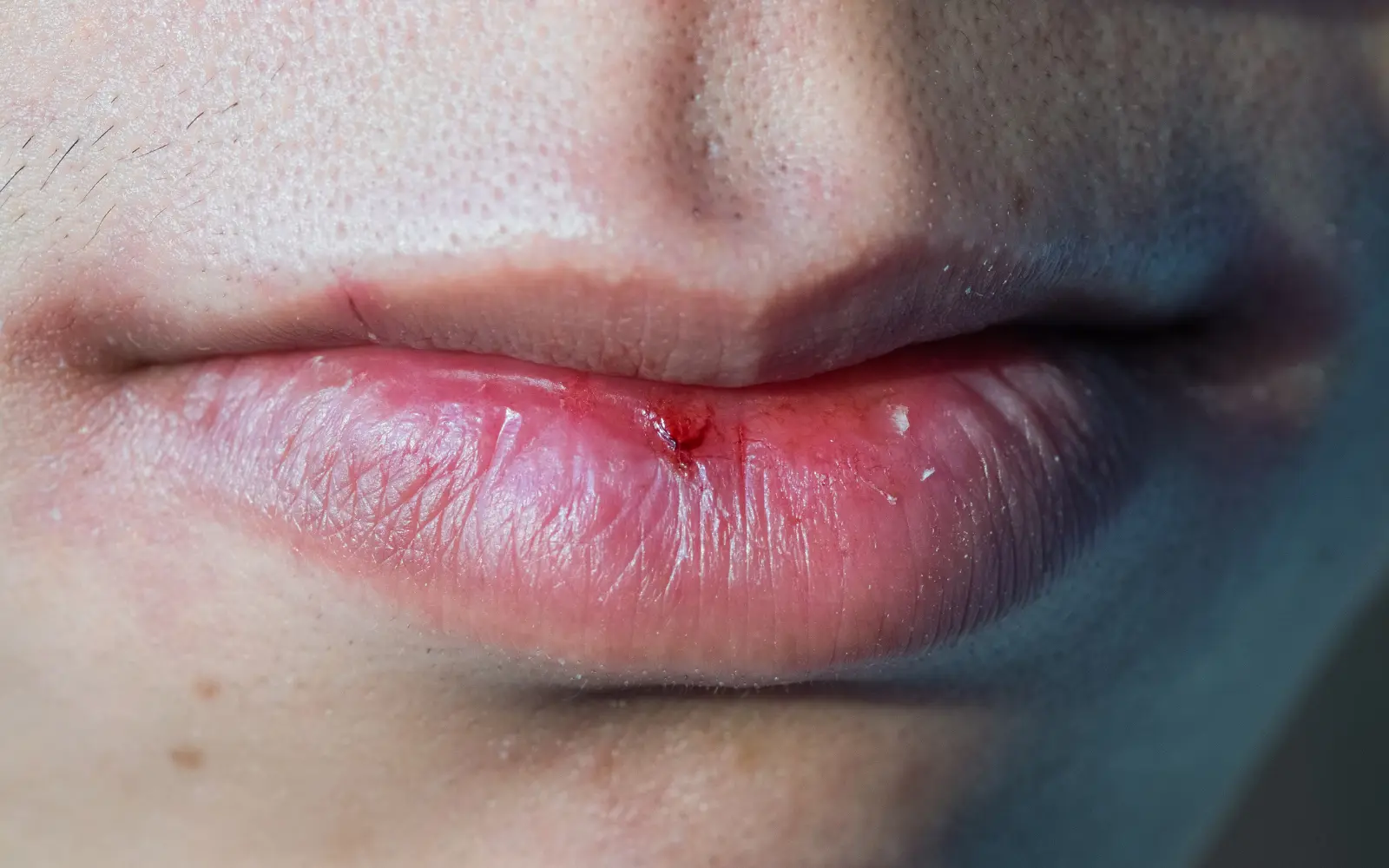 Labios secos: causas y cómo hidratarlos correctamente